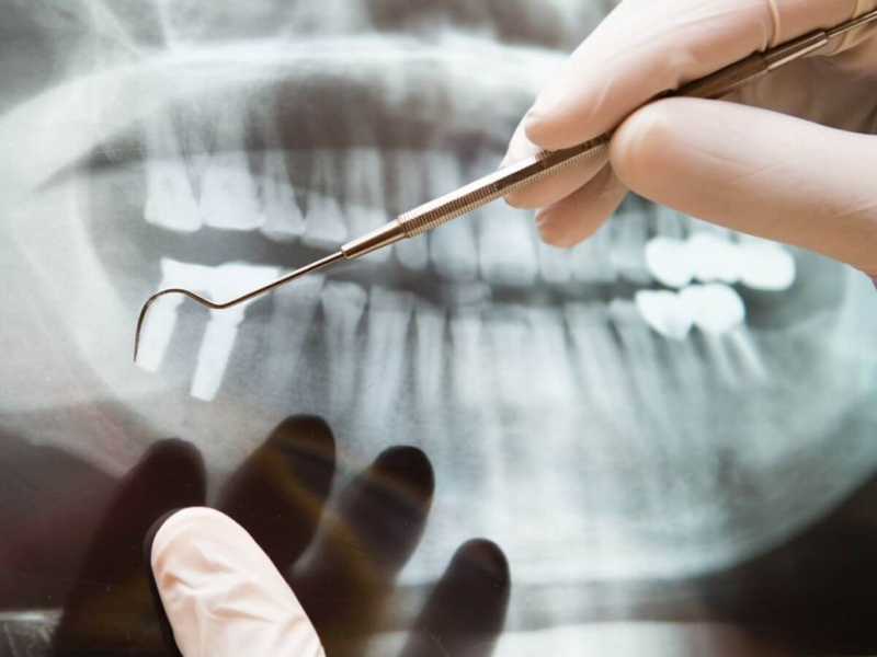 Endodonti